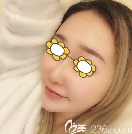 做埋線提升術(shù)后90天效果