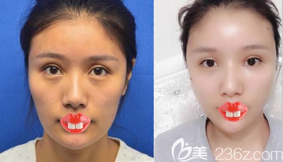 美貝爾趙主任全臉自體脂肪填充前后對比效果 美貝爾趙主任全臉自體脂肪填充前后對比效果