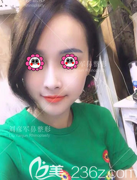 我找北京沃爾整形馮雁平做肋軟骨鼻綜合后改善了塌鼻及鼻尖低平等問題