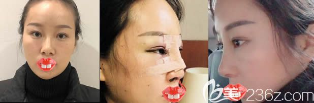 福州美貝爾趙棟材肋軟骨隆鼻前后對比照 福州美貝爾趙棟材肋軟骨隆鼻前后對比照