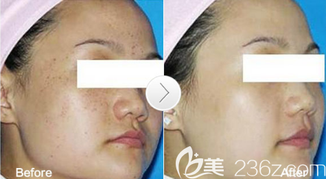 廣元醫(yī)而美美華趙艷王者之風(fēng)去雀斑案例 廣元醫(yī)而美美華趙艷王者之風(fēng)去雀斑案例