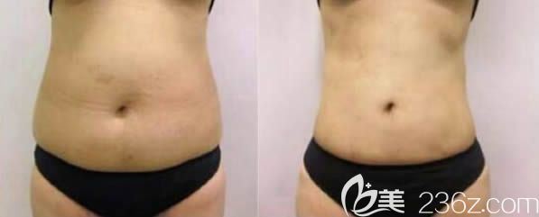 趙棟材醫(yī)生腰腹吸脂前后對比案例 趙棟材醫(yī)生腰腹吸脂前后對比案例