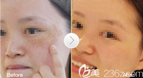 廣元美華趙艷黃褐斑治療效果 廣元美華趙艷黃褐斑治療效果