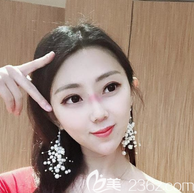 佛山佳麗隆鼻7天拆線了 佛山佳麗隆鼻7天拆線了