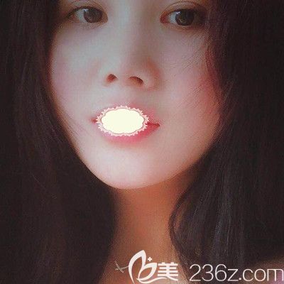 武漢壹加壹醫(yī)療整形美容醫(yī)院王政祥醫(yī)生瘦臉除皺瘦臉術(shù)前照 武漢壹加壹醫(yī)療整形美容醫(yī)院王政祥醫(yī)生瘦臉除皺瘦臉術(shù)前照