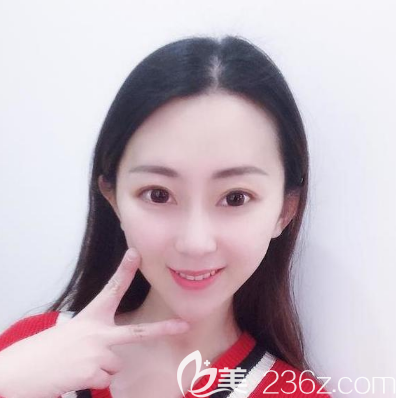 親身體驗(yàn)后告訴你佛山佳麗整形醫(yī)院于立民做鼻綜合隆鼻子技術(shù)怎么樣