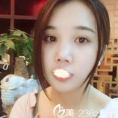 武漢壹加壹王政祥醫(yī)生瘦臉術(shù)后0天效果 武漢壹加壹王政祥醫(yī)生瘦臉術(shù)后0天效果