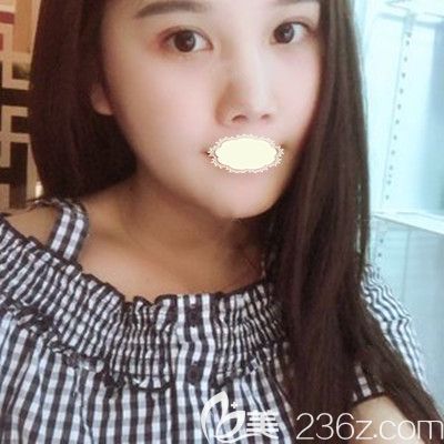 武漢壹加壹王政祥醫(yī)生瘦臉術(shù)后7天案例照 武漢壹加壹王政祥醫(yī)生瘦臉術(shù)后7天案例照