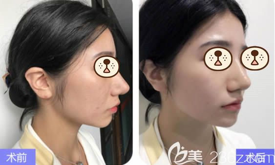 福州美貝爾整形醫(yī)院薛欣醫(yī)生玻尿酸豐下巴前后對比效果 福州美貝爾整形醫(yī)院薛欣醫(yī)生玻尿酸豐下巴前后對比效果