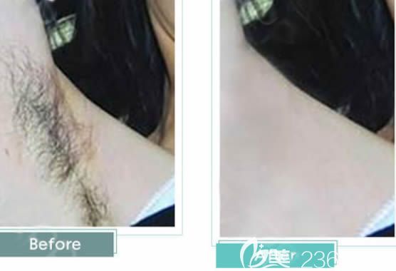 福州美貝爾陳醫(yī)生激光脫腋毛前后對比照片