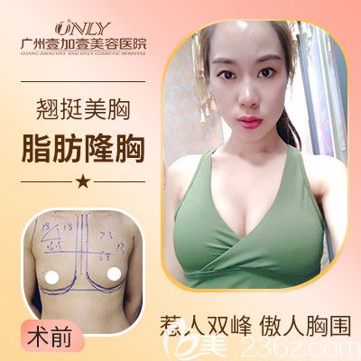 廣州壹加壹張紅艷隆胸<span style=