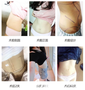 廣州軍美肖強吸脂<span style=