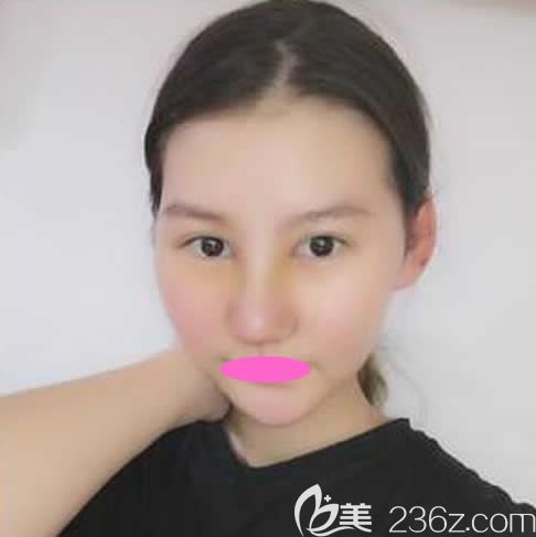 去贛州亞韓整形醫(yī)院做鼻綜合手術(shù)第3天照片 去贛州亞韓整形醫(yī)院做鼻綜合手術(shù)第3天照片