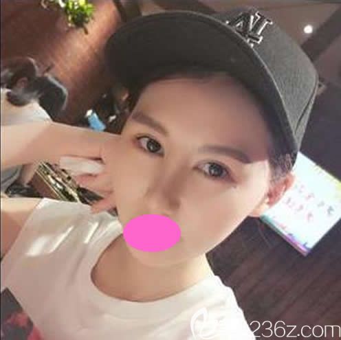 贛州隆鼻哪里好?看我找贛州亞韓“金鼻子”金輝做鼻綜合手術1-7天的照片