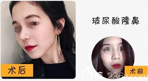 任勃主任玻尿酸隆鼻前后對比照 任勃主任玻尿酸隆鼻前后對比照