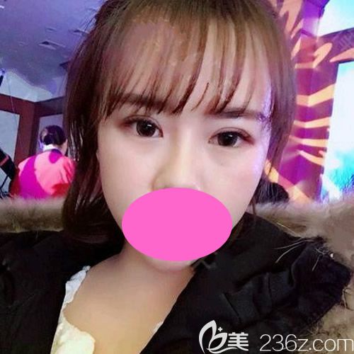 腫眼泡的我到西寧整形醫(yī)院排名前三韓美做了全切雙眼皮，術(shù)后1個月過程圖分享