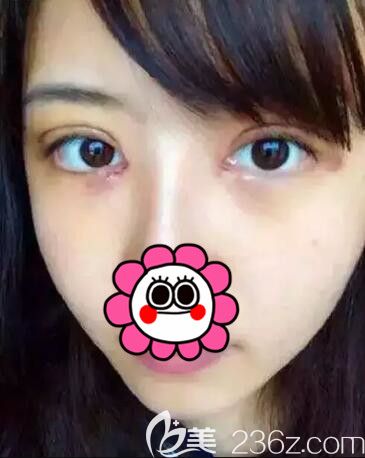 做完眼綜合術(shù)后第三天恢復(fù)情況