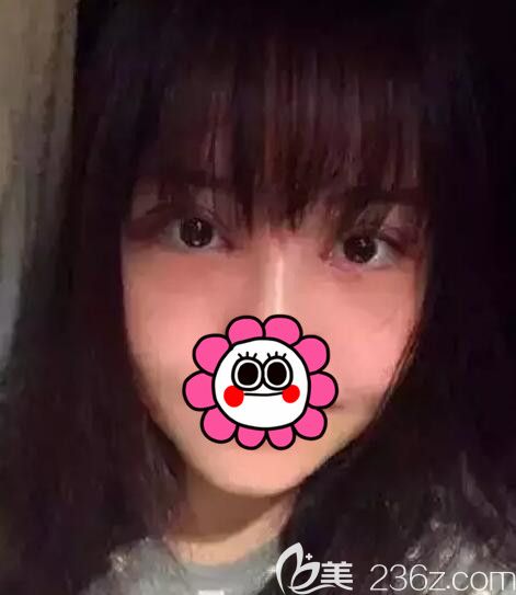 常熟時(shí)代分享眼綜合術(shù)后一周拆線恢復(fù)