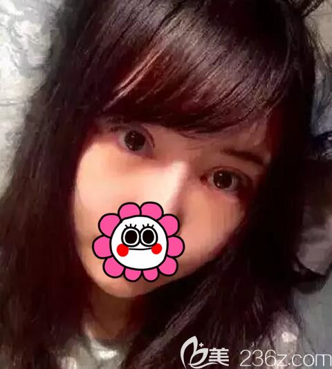 做完雙眼皮開(kāi)眼角去皮去脂術(shù)后半個(gè)月恢復(fù)情況