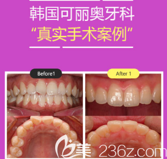 韓國(guó)可麗奧牙科醫(yī)院牙齒隱形矯正案例