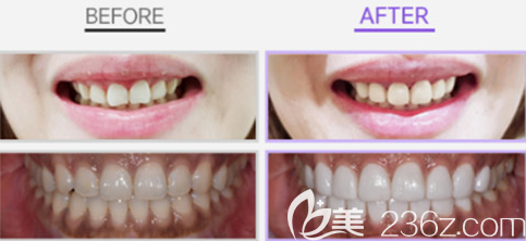 韓國(guó)牙貼面哪家醫(yī)院好？韓國(guó)可麗奧案例