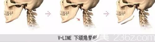 韓國面部輪廓手術(shù) 韓國面部輪廓手術(shù)