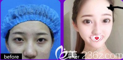 石家莊天伊美雙眼皮案例 石家莊天伊美雙眼皮案例