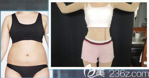 天伊美整形醫(yī)院做腰腹吸脂案例 天伊美整形醫(yī)院做腰腹吸脂案例