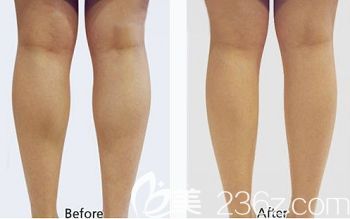 石家莊天伊美注射瘦腿案例 石家莊天伊美注射瘦腿案例