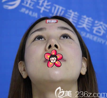 金華亞美整形做鼻修復(fù)術(shù)前 金華亞美整形做鼻修復(fù)術(shù)前