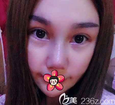 金華亞美做鼻修復(fù)和雙眼皮<span style= 金華亞美做鼻修復(fù)和雙眼皮<span style=