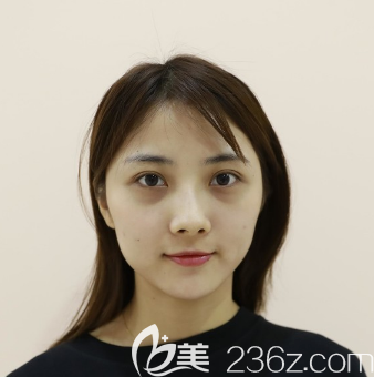 自體脂肪全臉填充術(shù)前照 自體脂肪全臉填充術(shù)前照