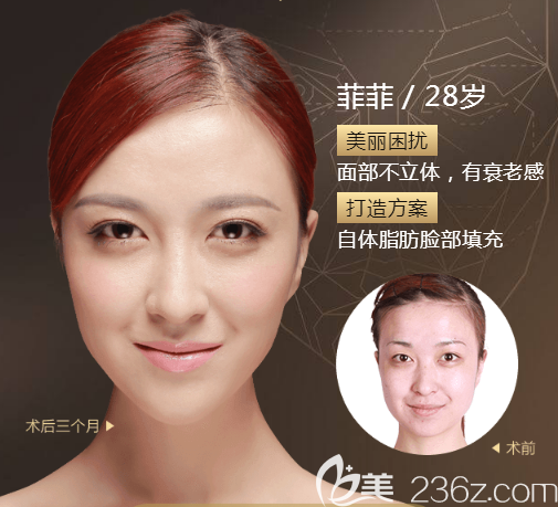 找廣州美萊<!--<i data=20240703-sp></i>-->做的脂肪填充消腫很快