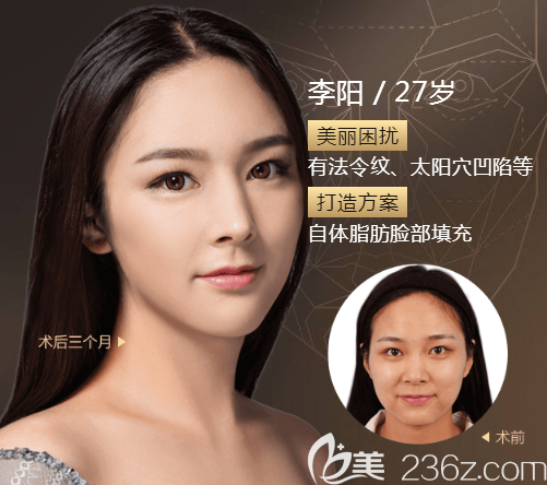 廣州美萊<!--<i data=20240703-sp></i>-->面部脂肪填充案例