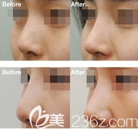韓國美泊門隆鼻案例前后效果對比圖 韓國美泊門隆鼻案例前后效果對比圖