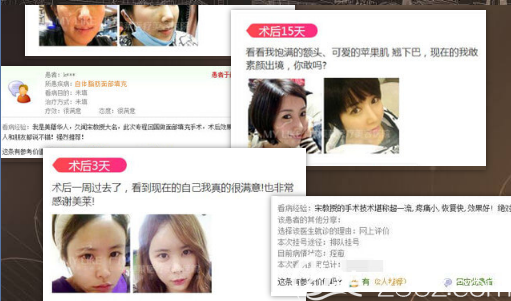 愛(ài)美者對(duì)<!--<i data=20240703-sp></i>-->做的脂肪填充術(shù)后真實(shí)評(píng)價(jià)