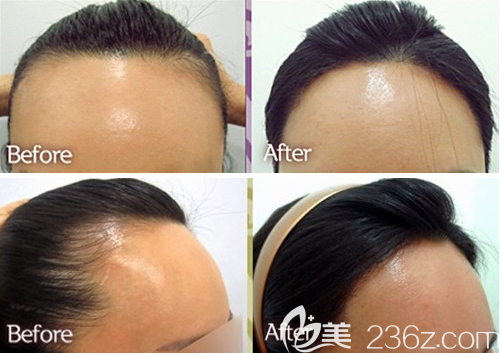 韓國美泊門發(fā)際線種植案例前后效果對比圖 韓國美泊門發(fā)際線種植案例前后效果對比圖