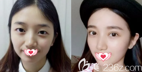 <!--<i data=20240703-sp></i>-->雙眼皮手術(shù)案例