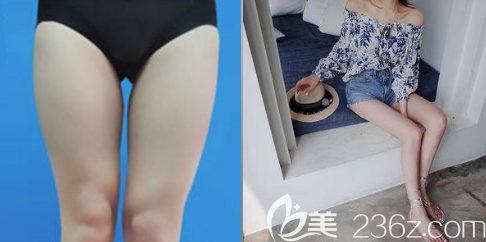 <!--<i data=20240703-sp></i>-->吸脂案例