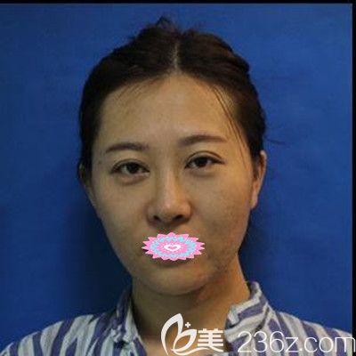 武漢壹加壹醫(yī)療整形內(nèi)容醫(yī)院李艷東醫(yī)生自體脂肪面部填充術(shù)前照 武漢壹加壹醫(yī)療整形內(nèi)容醫(yī)院李艷東醫(yī)生自體脂肪面部填充術(shù)前照