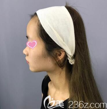 在斯美諾做鼻綜合術(shù)前照 在斯美諾做鼻綜合術(shù)前照