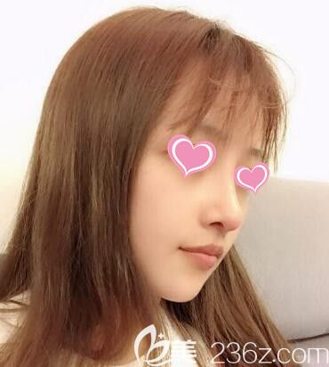 做鼻綜合整形術(shù)后30天效果 做鼻綜合整形術(shù)后30天效果