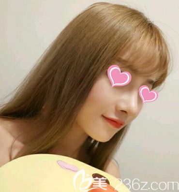 在錦州斯美諾做鼻綜合術(shù)后90天效果 在錦州斯美諾做鼻綜合術(shù)后90天效果