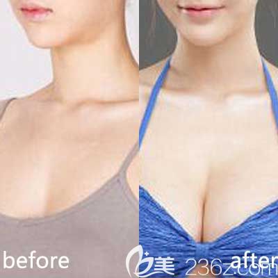 許田海醫(yī)生隆胸前后對比照