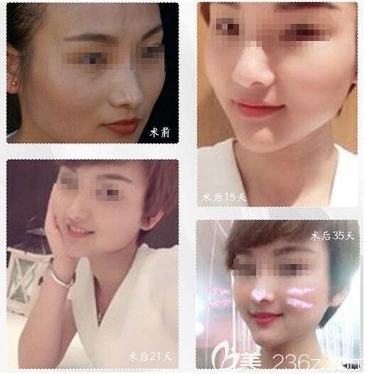 朱志杰醫(yī)生自體脂肪填充對比案例