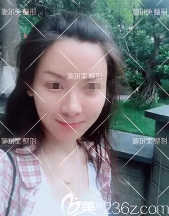 打聽到小姐妹做埋線提升效果不錯，也面診了常州施爾美做4D夢幻線雕術(shù)告別中下面部松弛下垂、皺紋明顯