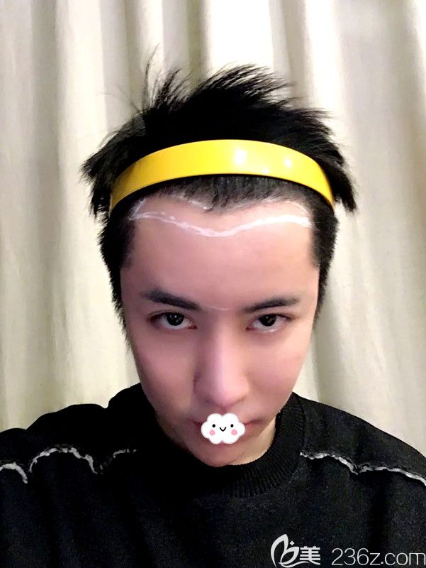 韓國凱倫秀整形醫(yī)院額頭縮小術(shù)前設(shè)計(jì)