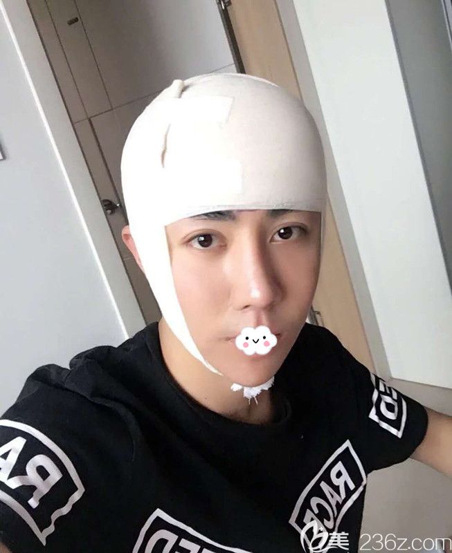 不想做植發(fā)到韓國凱倫秀做額頭縮小術(shù)后即刻照片