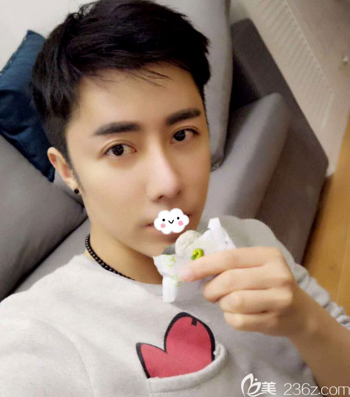 額頭發(fā)際線太高怎么辦?不想做植發(fā)到韓國凱倫秀額頭縮小術(shù)后半年恢復(fù)效果圖