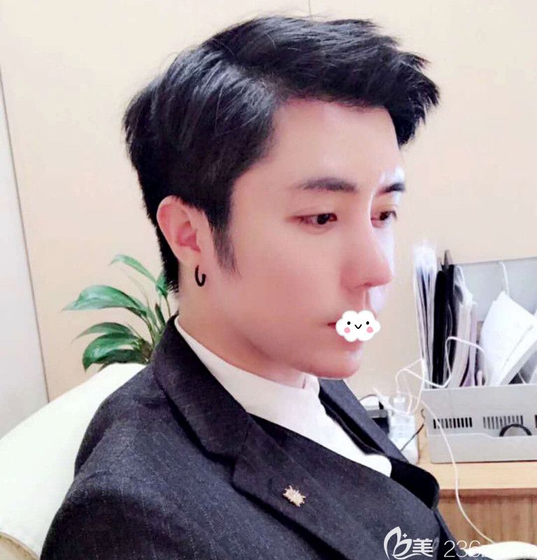 不做發(fā)際線種植到韓國凱倫秀做額頭縮小術(shù)后半年恢復(fù)效果圖